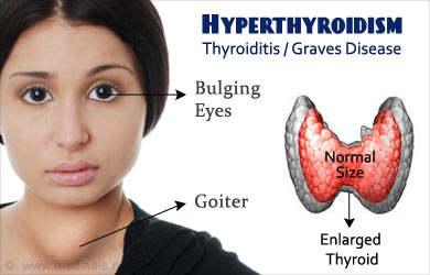 hyperthyroidism thyroid treatment disease overactive graves herbal gland holistic disorder ayurvedic remedies goitre goiter dysfunction ayurveda headaches definitions dr homeopathic