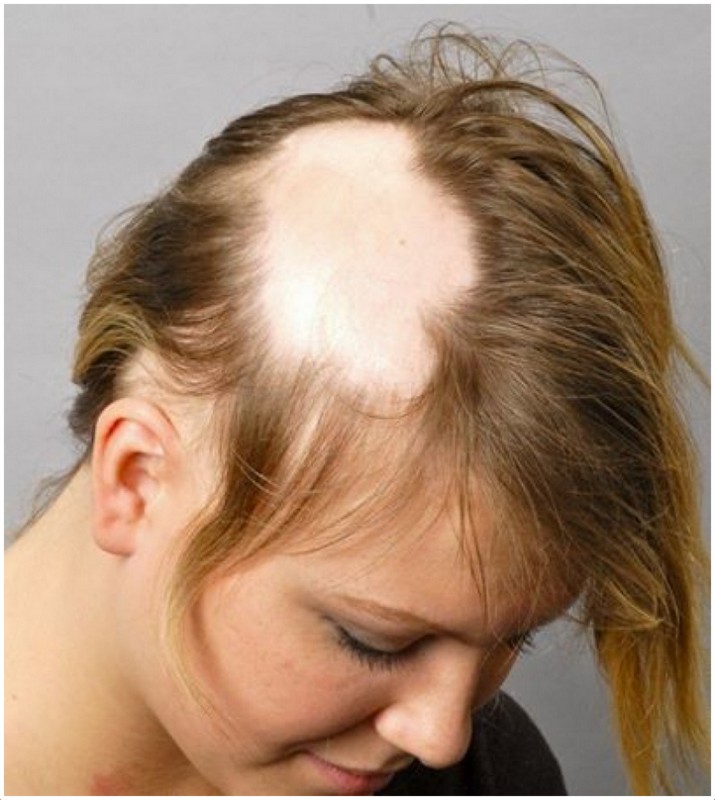 Hair loss - boldness