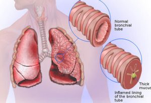 Bronchitis & Asthma - Homeopathic treatment in Philadelphia by Dr Tsan