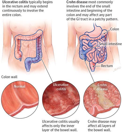 Crohn’s Disease homeopathic treatment by Medical Doctor Victor Tsan