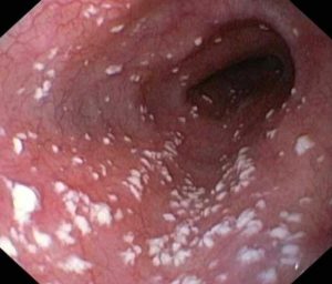 Treatment for Candidiasis known as vaginal Yeast Infection ...