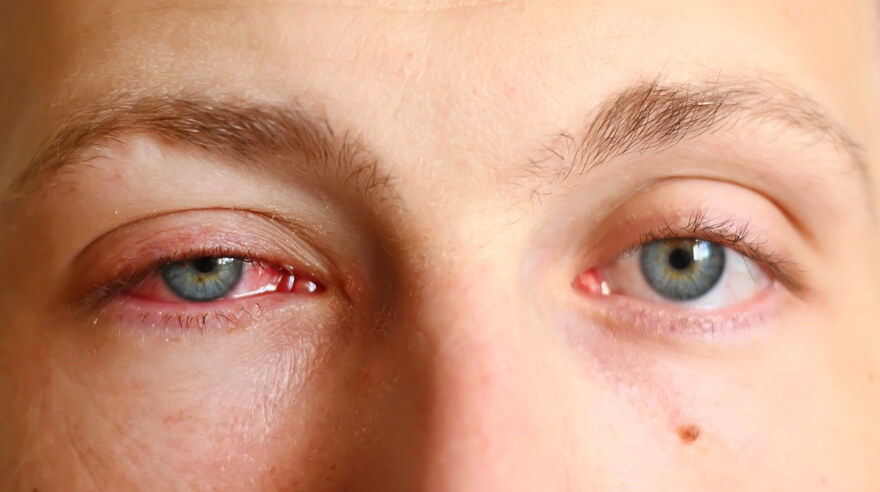 Conjunctivitis