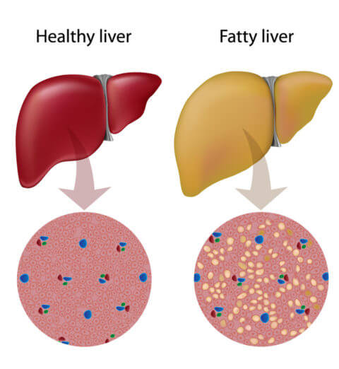 Treatment for Fatty Liver - Philadelphia Homeopathic Clinic - Dr. Tsan & Co