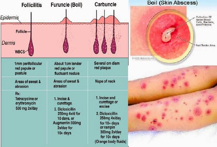 TREATMENT FOR BOILS By Dr Tsan At Philadelphia Homeopathic Clinic