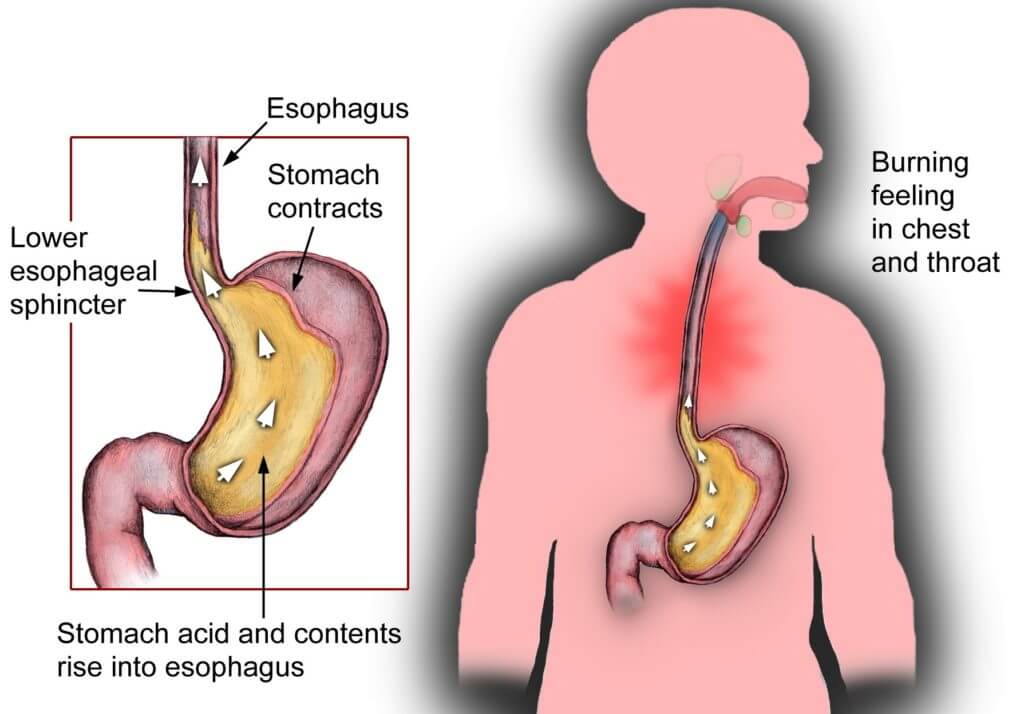 Acid Reflux