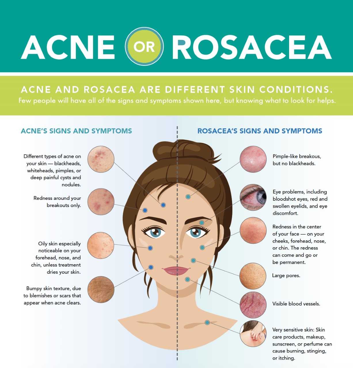 Treatment for Acne | Philadelphia Homeopathic Clinic| Dr. Tsan & Assoc.