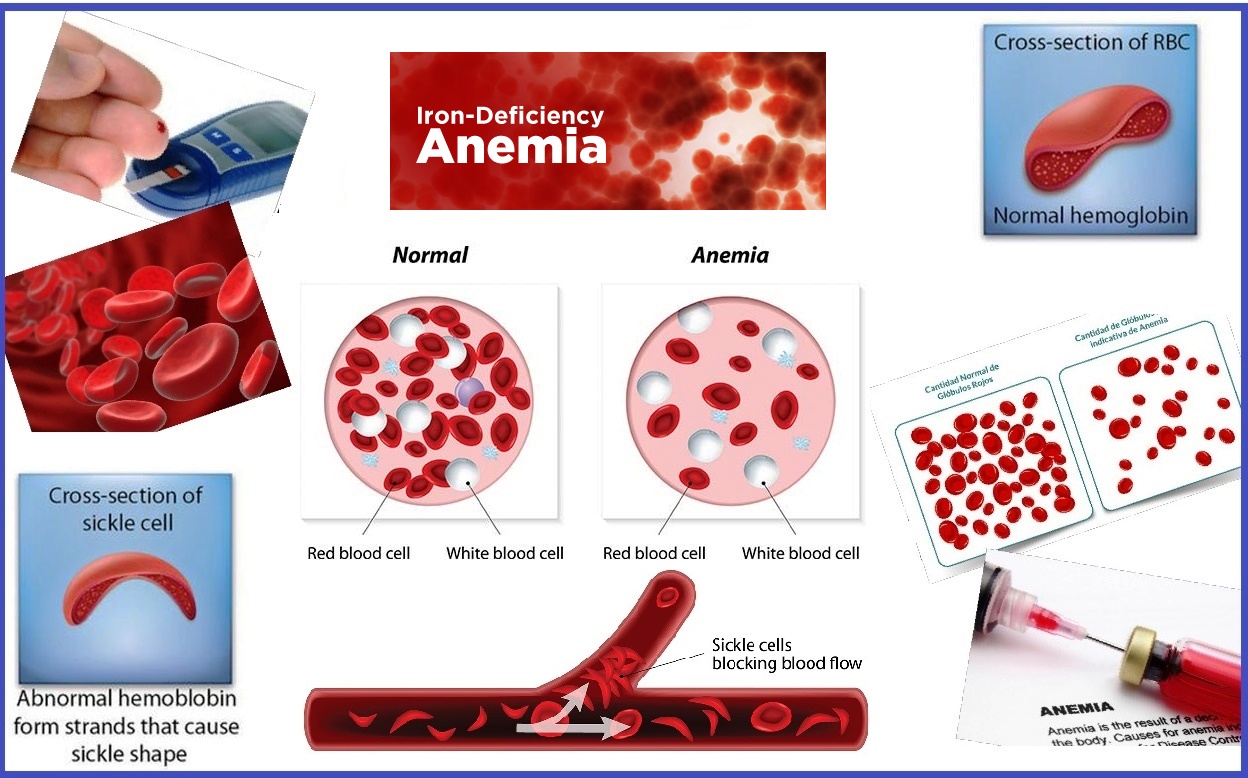 Treatment For Anemia Homeopathic Medicine For Anemia Treatment 6403