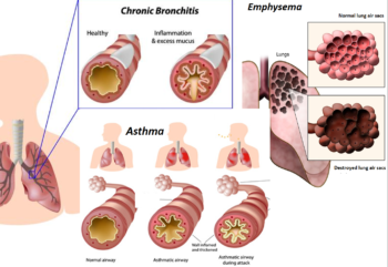 can ace inhibitors cause wheezing