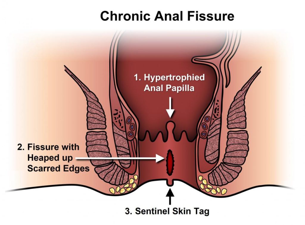 What is anal fissure