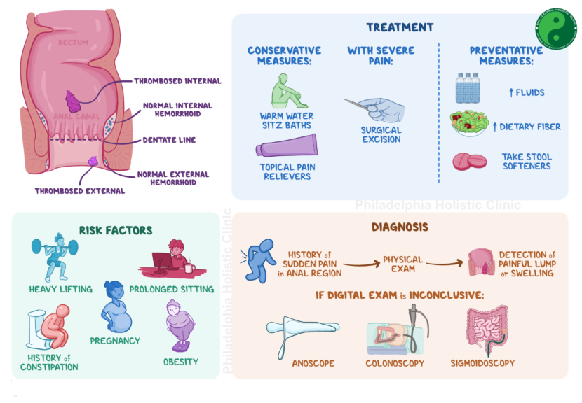 Treatment for Hemorrhoids - Philadelphia Homeopathic Clinic