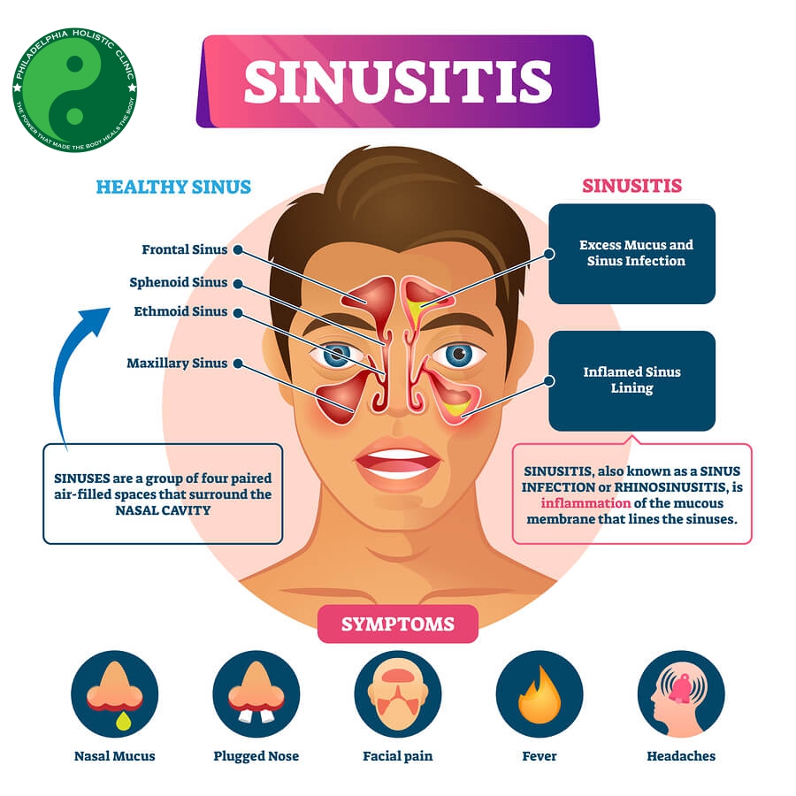 Treatment For Sinus Infection Philadelphia Homeopathic Clinic Dr Tsan