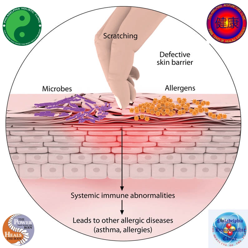 Causes of eczema