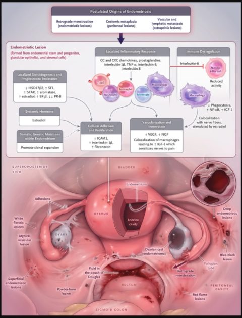 Treatment For Endometriosis Philadelphia Homeopathic Clinic Dr Tsan