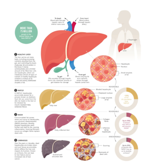 Treatment for Fatty Liver - Philadelphia Homeopathic Clinic - Dr. Tsan & Co