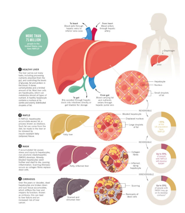 Fatty Liver Disease