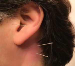 Acupuncture for tinnitus