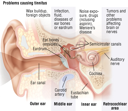 Causes of tinnitus