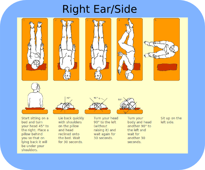 Epley maneuver