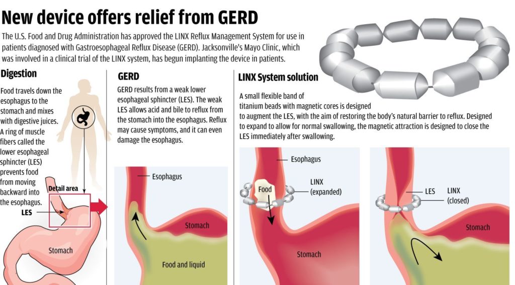 Surgical treatment for Acid Reflux