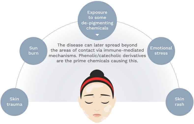 causes of leukoderma