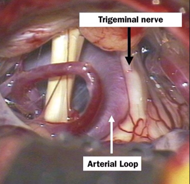 Microvascular decompression