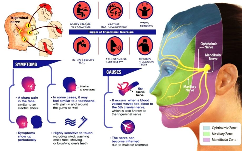 Treatment for Trigeminal Neuralgia by Dr. Victor Tsan and associates