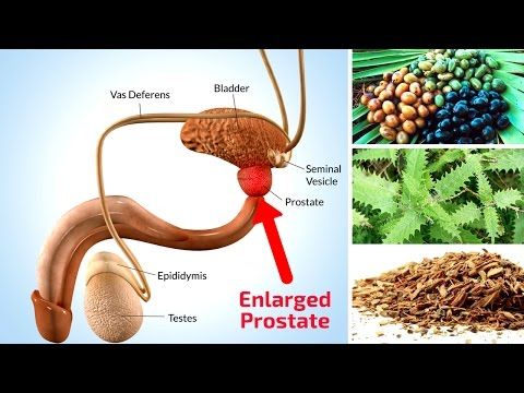 Natural Treatment for Prostate Enlargement