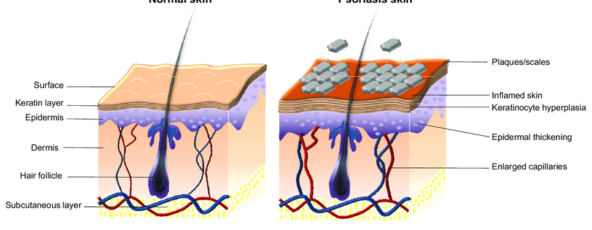 How proriasis develops