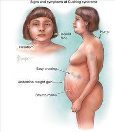 Cushing's syndrome