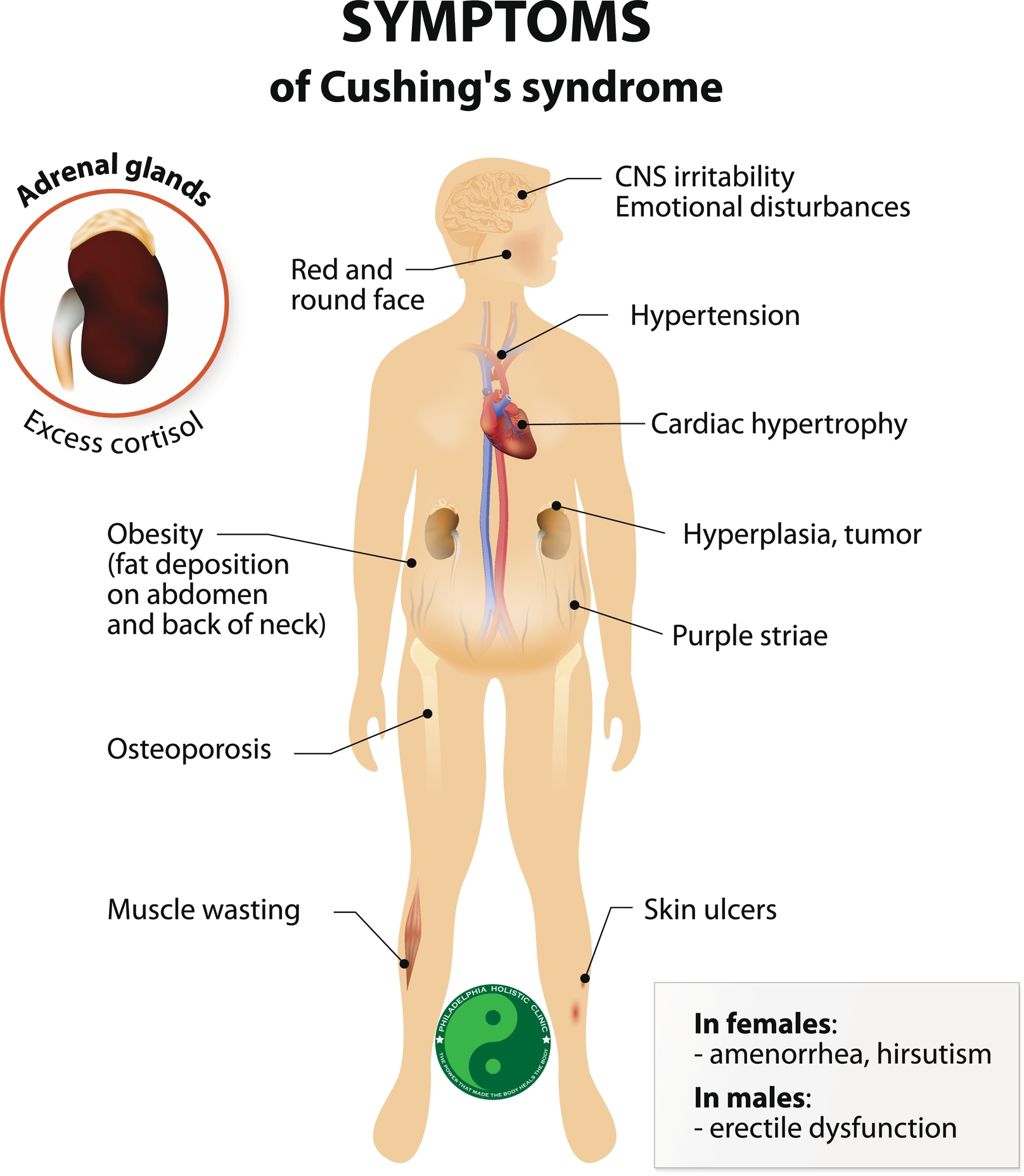 Treatment For Cushing S Syndrome Philadelphia Homeopathic Clinic