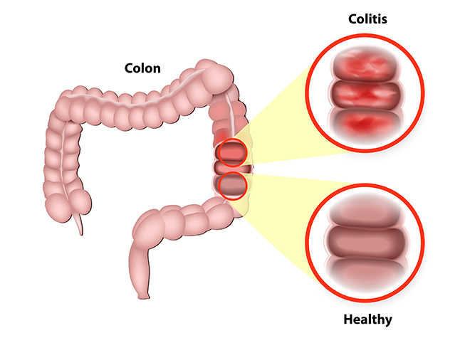 Colitis 