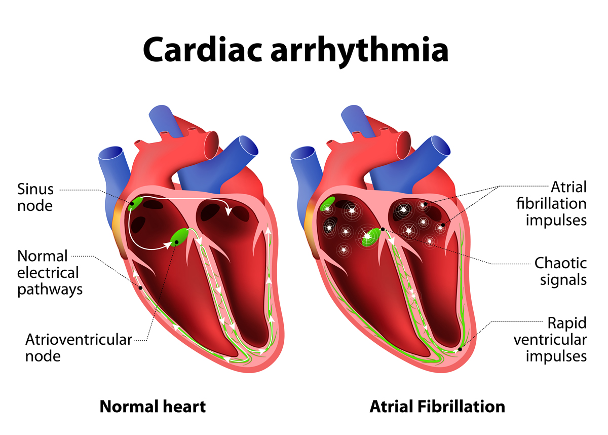 ARRHYTHMIA and Heart Palpitation