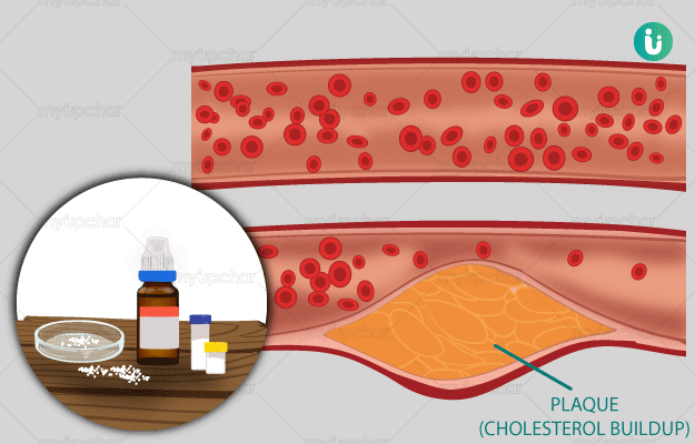 Homeopathic treatment for high cholesterol