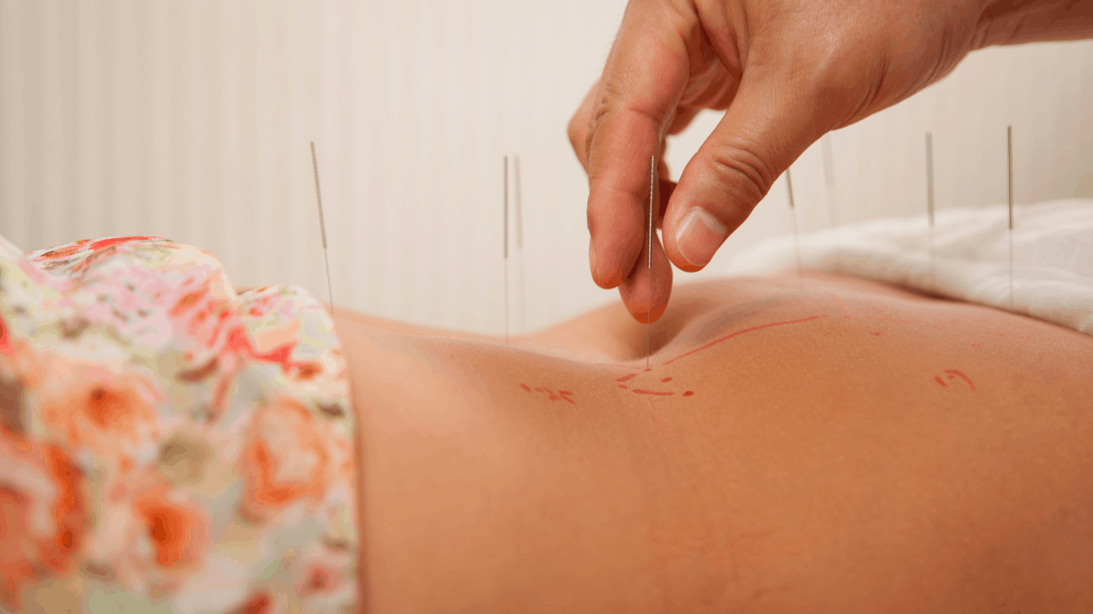 Acupuncture for multiple sclerosis