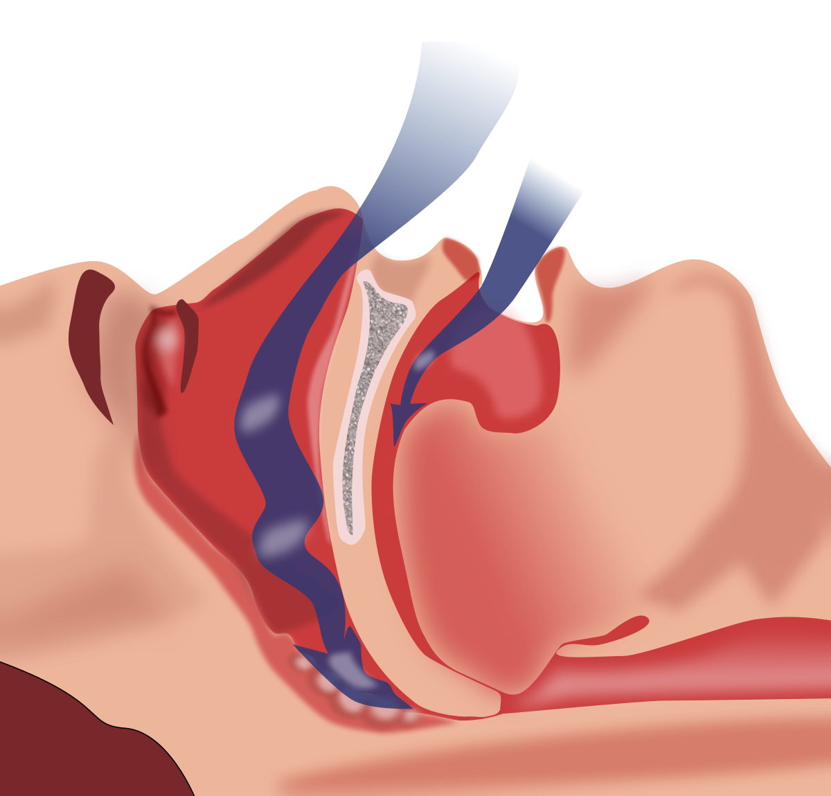 Sleep Apnea mechanism