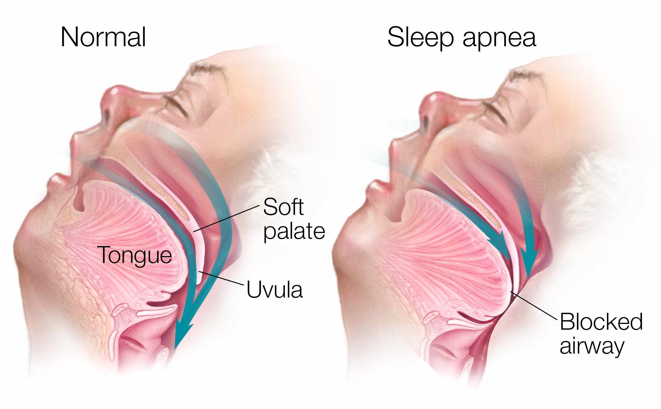 Sleep apnea