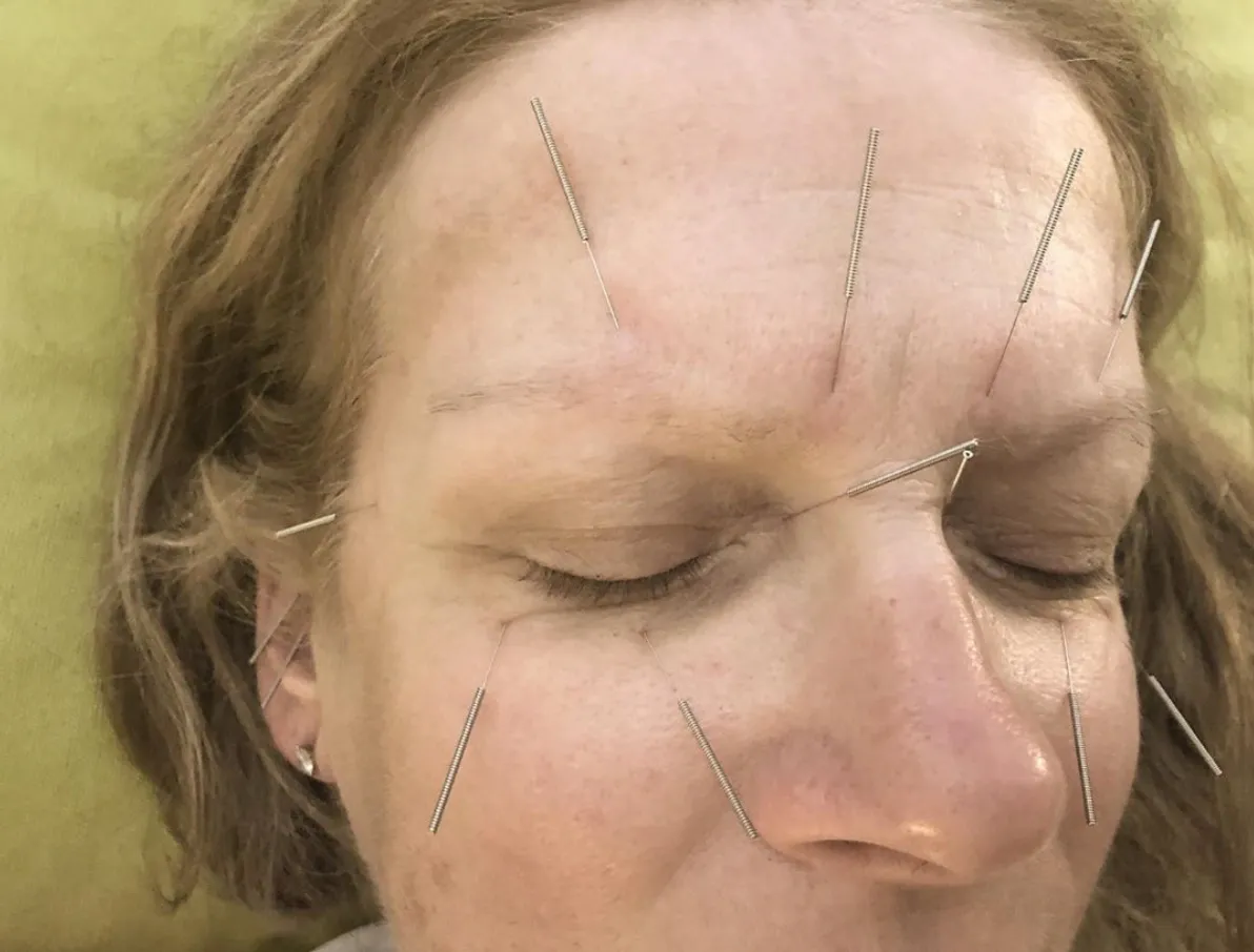 Snoring acupuncture