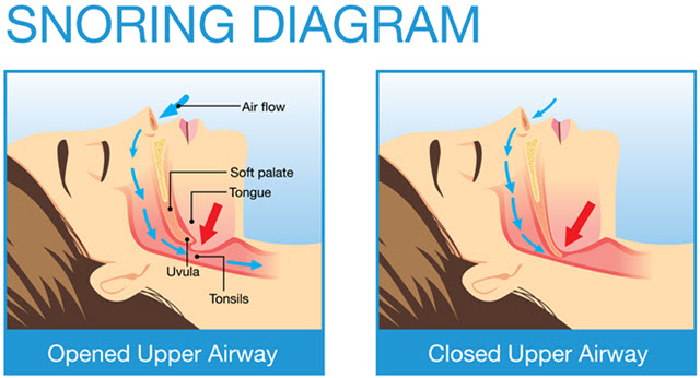snoring diagram
