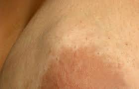 Fibroadenoma