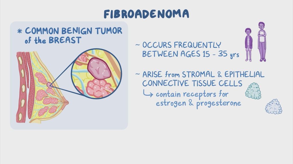 Fibroadenoma