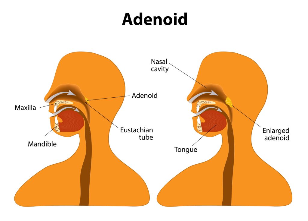 The adenoids