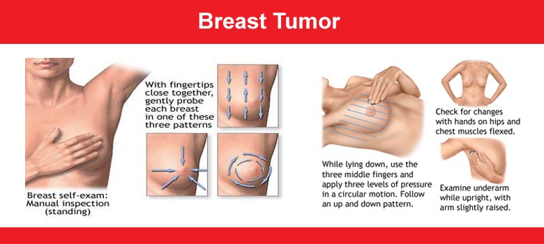 Breast tumor
