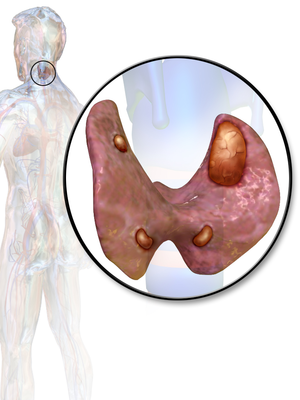 Hyperparathyroidism