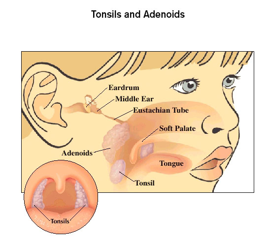 Treatment for Adenoids and Tonislitis 