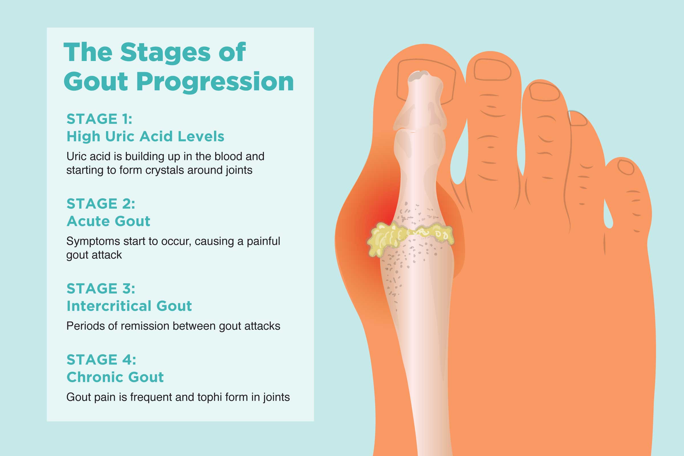 Stages and treatment for gout disease