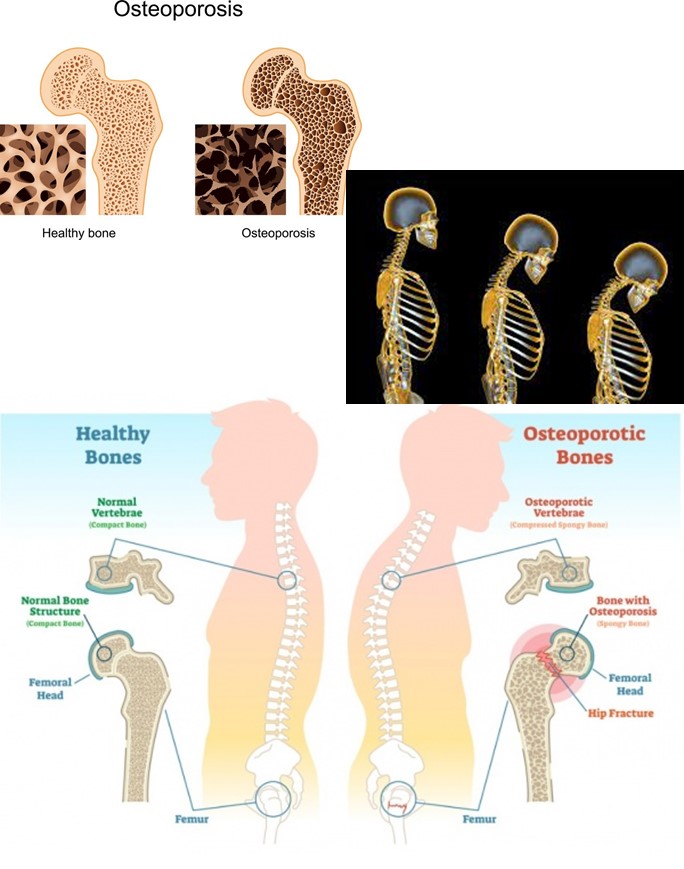 Osteoporosis
