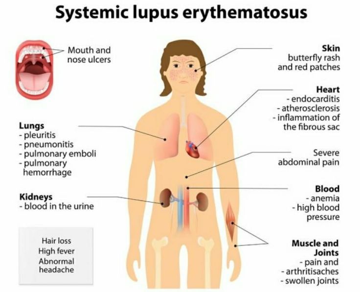 Lupus symptoms