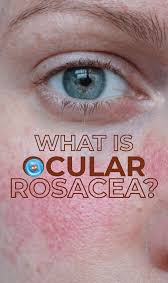Ocular couperoseis