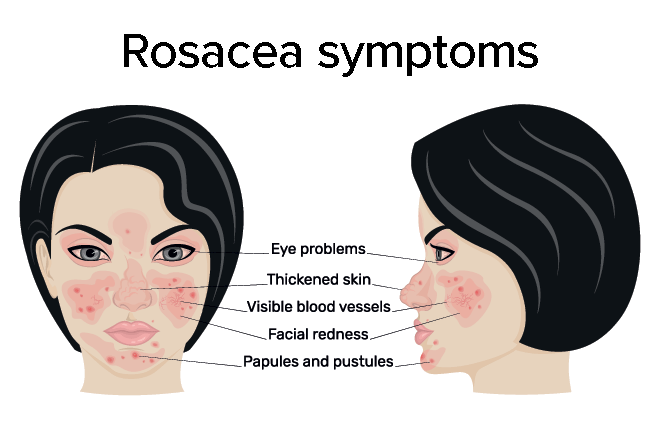 Rosacea symptoms