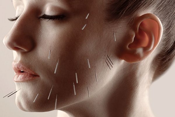 TMJ Acupuncture